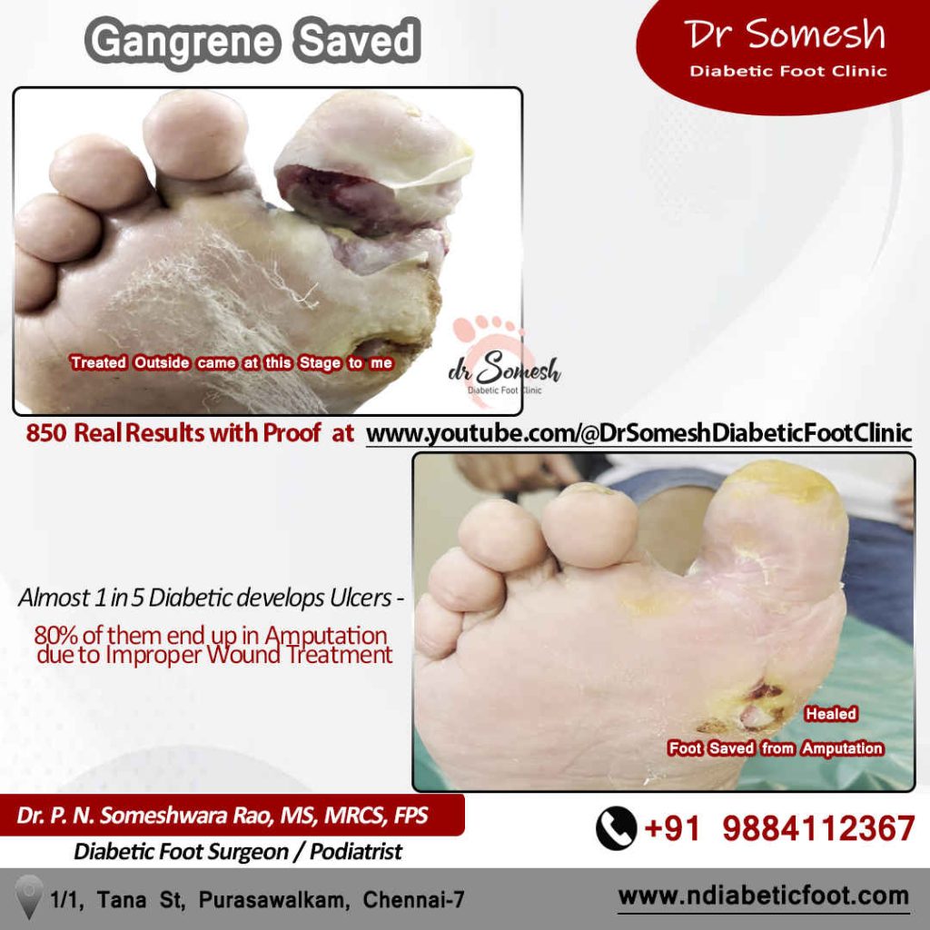 Podiatrist Chennai | Toe Infection