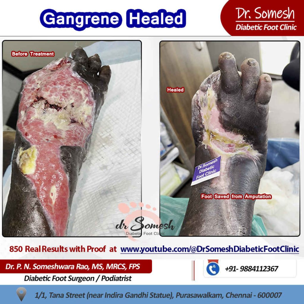 Podiatrist Chennai | Diabetic Foot Infection
