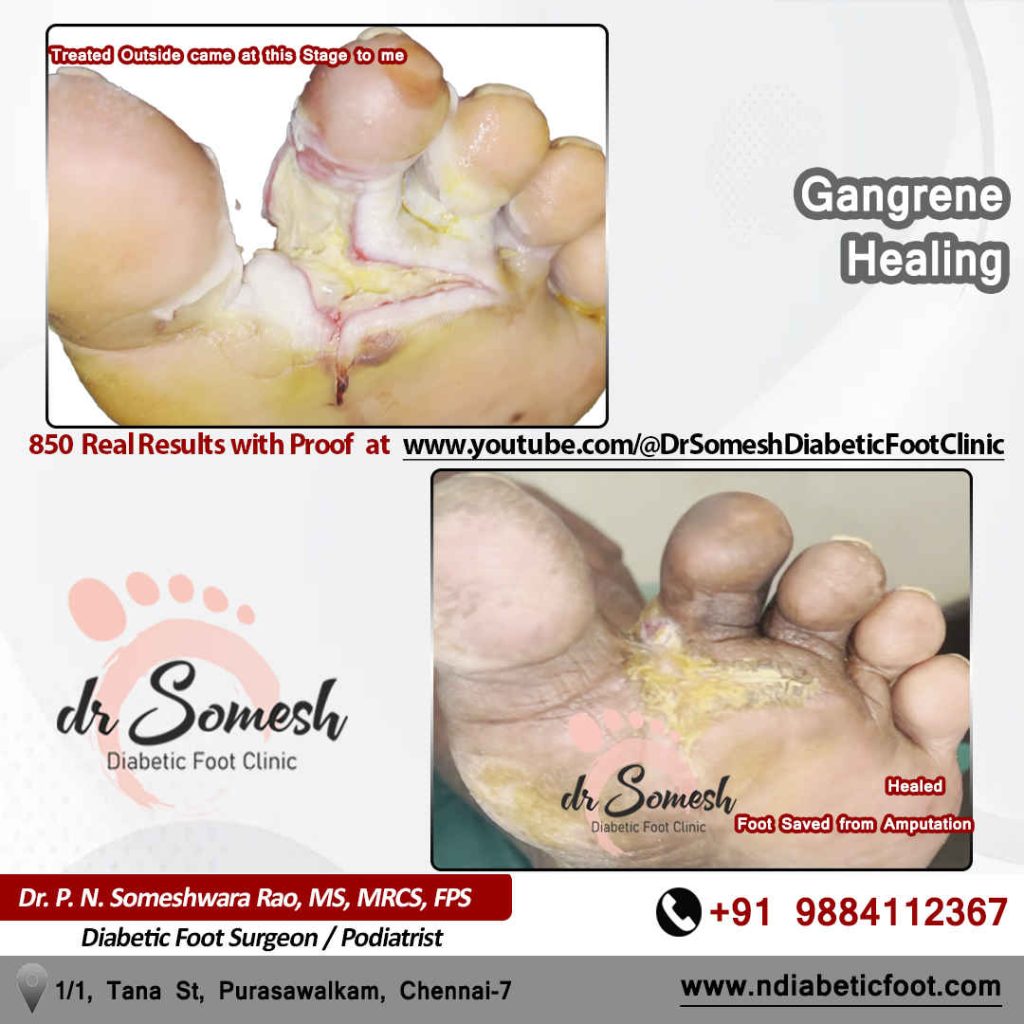 Podiatrist Chennai | Diabetic Foot Infection