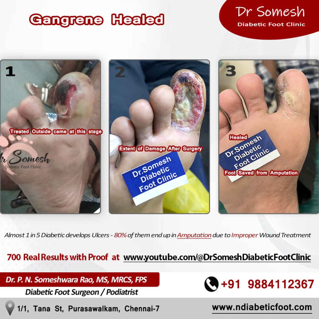 Podiatrist Chennai | Diabetic Foot Infection