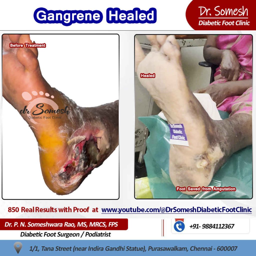 Podiatrist Chennai | Diabetic Foot Infection