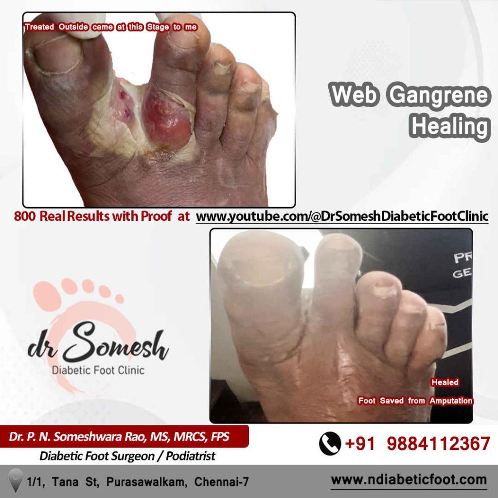 Podiatrist Chennai | Diabetic Foot Infection