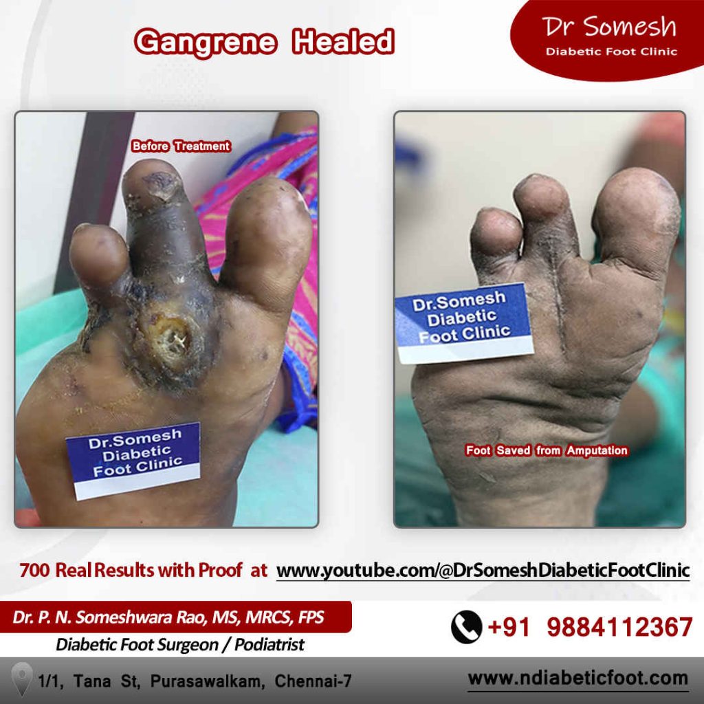 Podiatrist Chennai | Diabetic Foot Infection