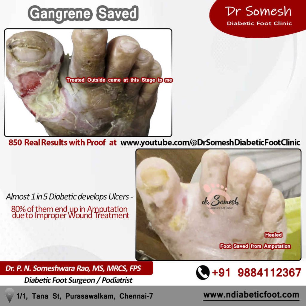 Podiatrist Chennai | Diabetic Foot Infection