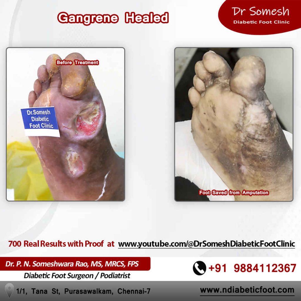 Podiatrist Chennai | Diabetic Foot Infection