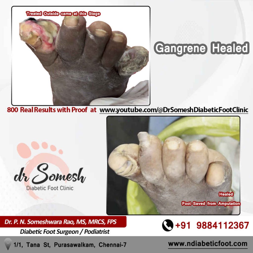 Podiatrist Chennai | Diabetic Foot Infection