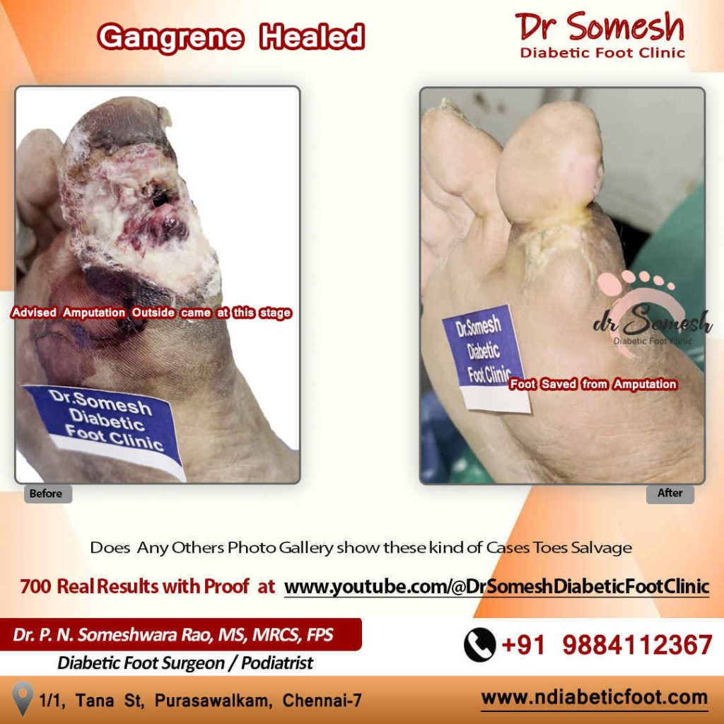 Podiatrist Chennai | Toe Infection